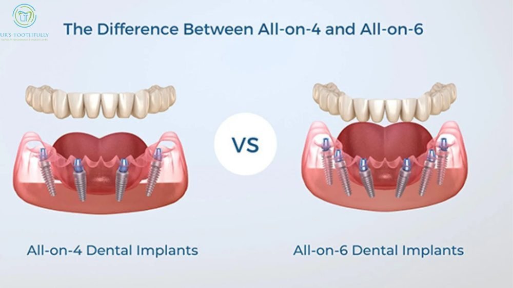 Ultimate Guide to All-on-4 vs. All-on-6 Dental Implants