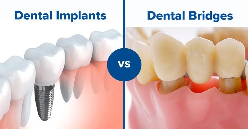 Dental Implants vs. Dental Bridges: Which Is Right for You?