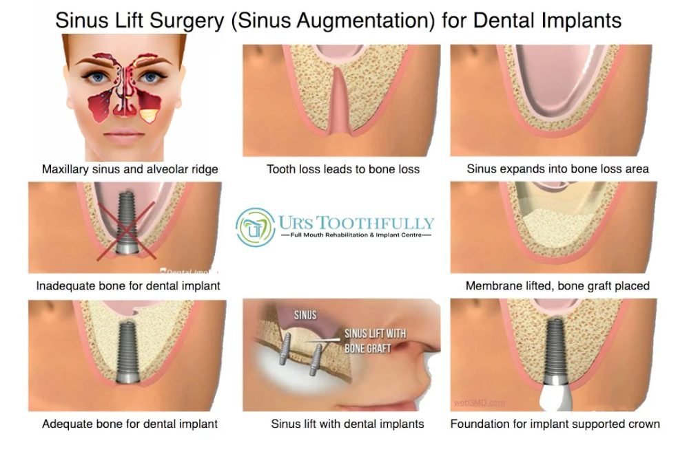 Know Sinus lift surgery for dental implants