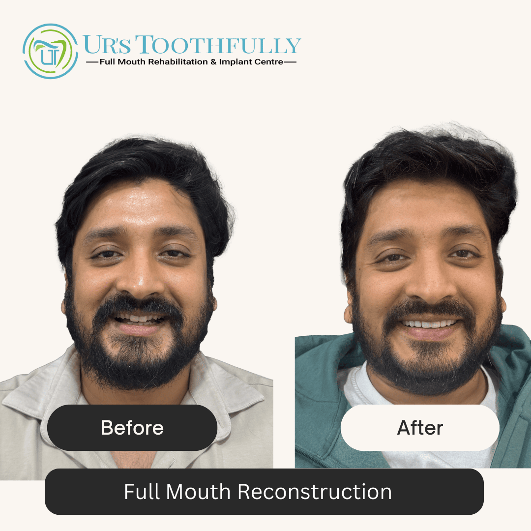 Full mouth reconstruction, before & after at Ur's Toothfully dental clinic in Kolkata
