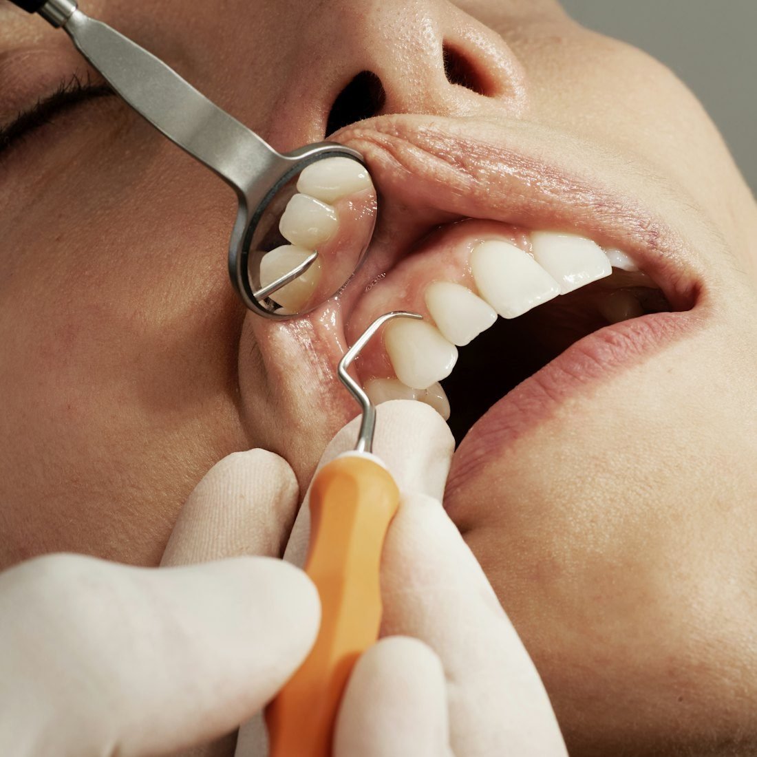 Bleeding Gums? Causes and Gum Disease Treatment in Kolkata