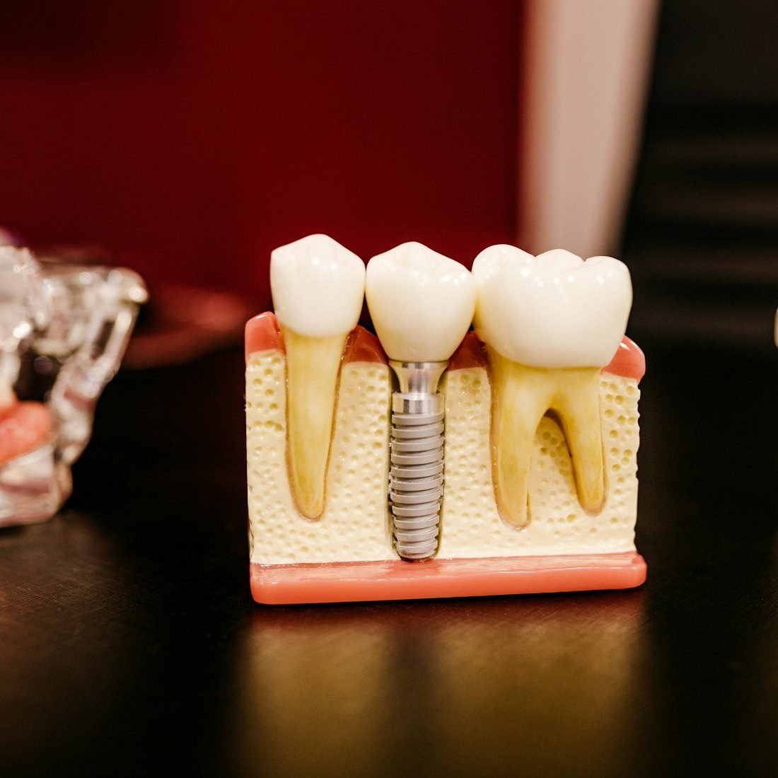 Are Dental Implants Painful? The Truth About Painless Dental Implants in Kolkata