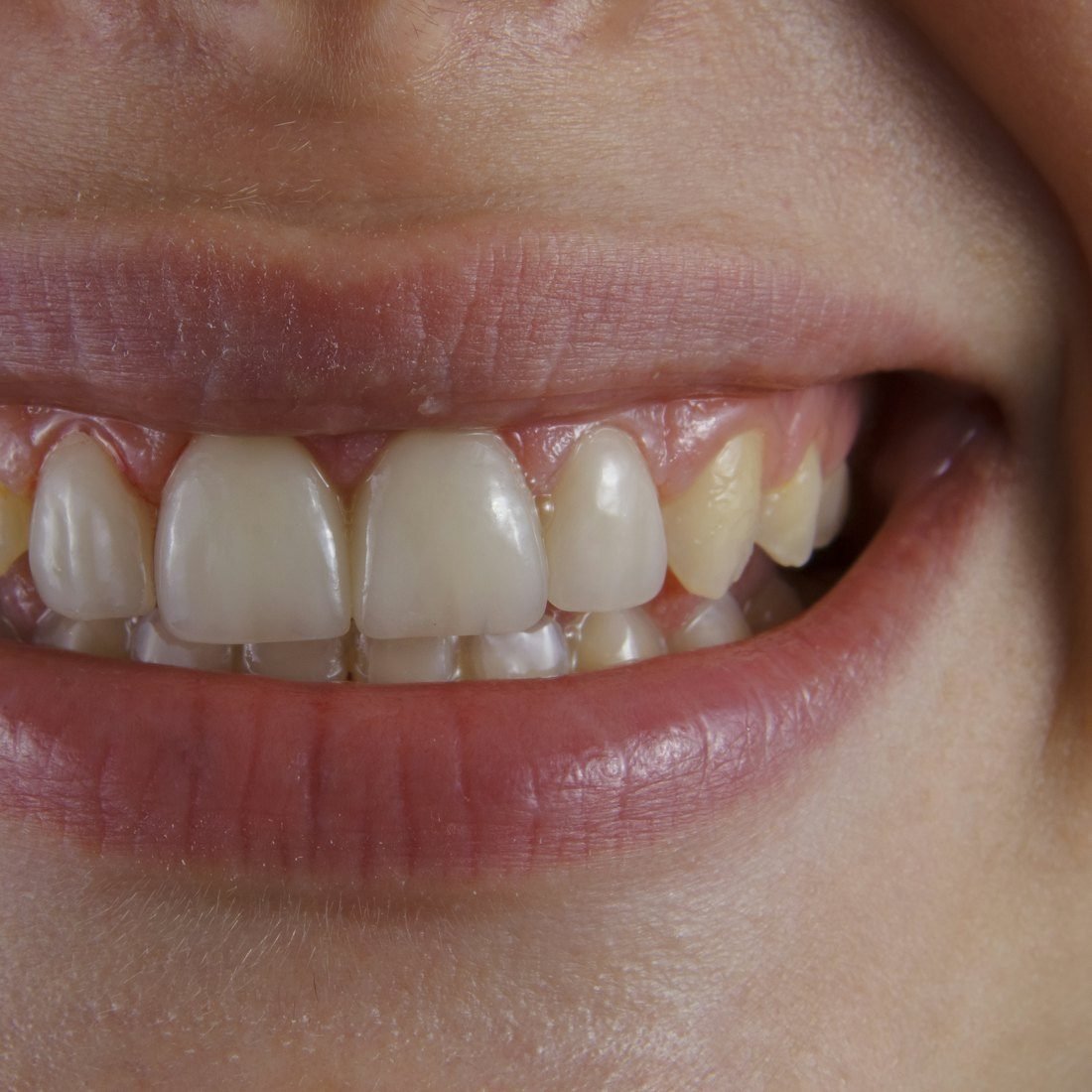 Teeth Whitening