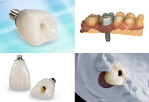 Dental Implant