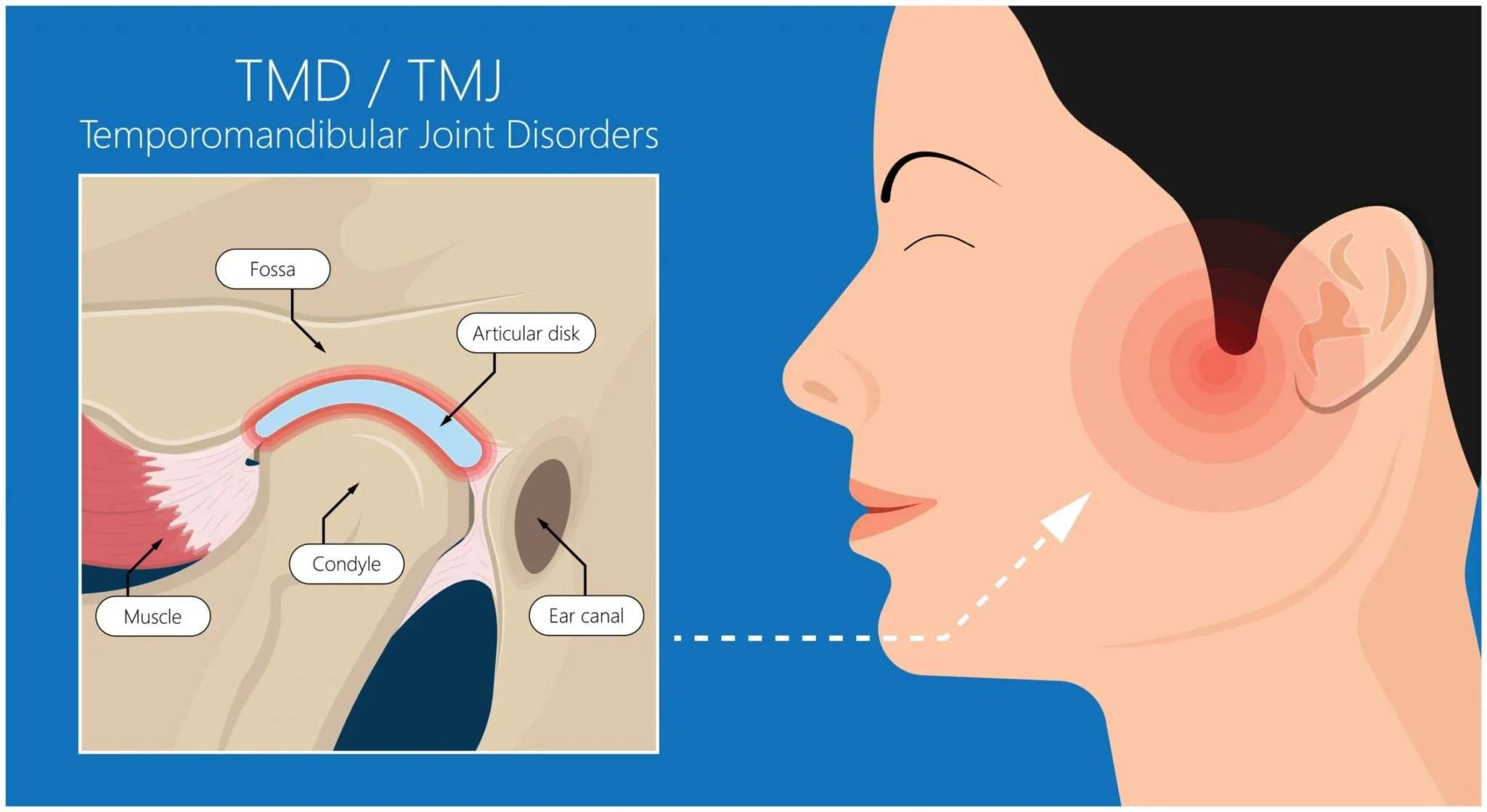 tmj pain scaled