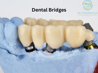 dental bridges