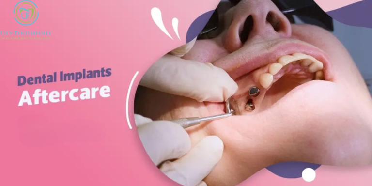 Dental Implant: Aftercare Procedure