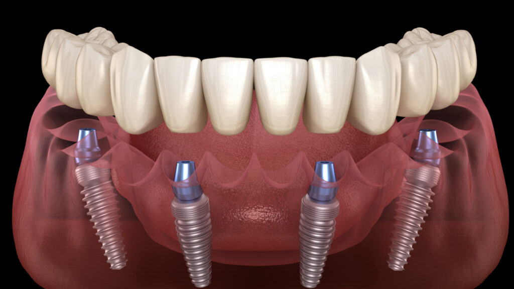 all on 4 dental implants