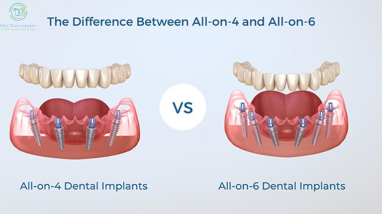 all on 4 vs all on 6 dental implants
